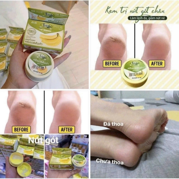 Kem trị nứt gót chân thái giá sỉ-tâm phát
